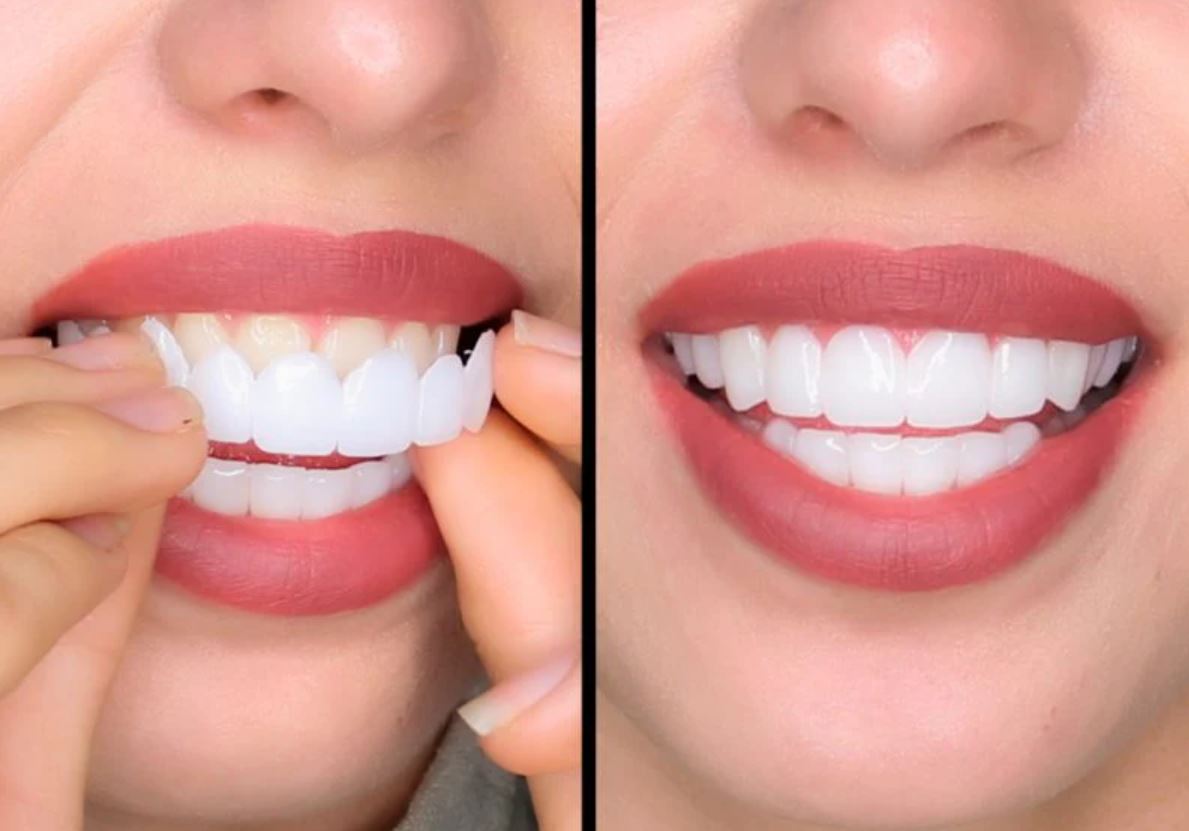 SnapOn Custom White Clip On/In Veneers DP3